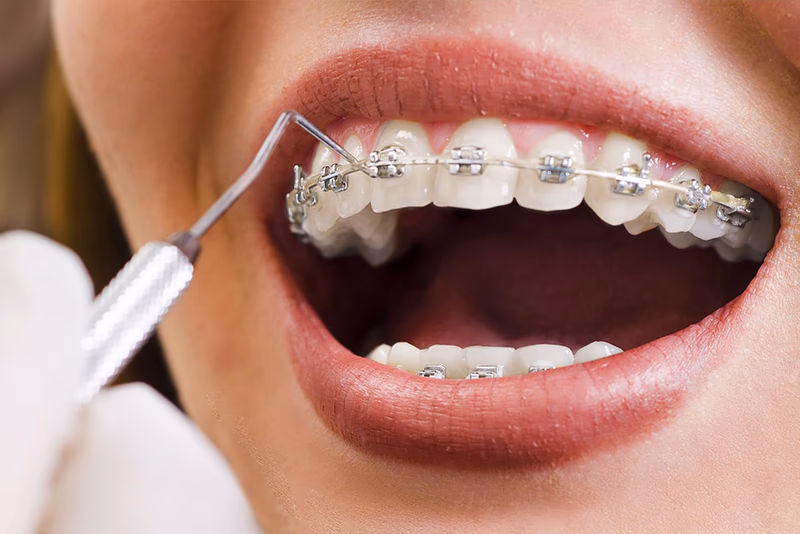 Orthodontie Invisalign Rabat